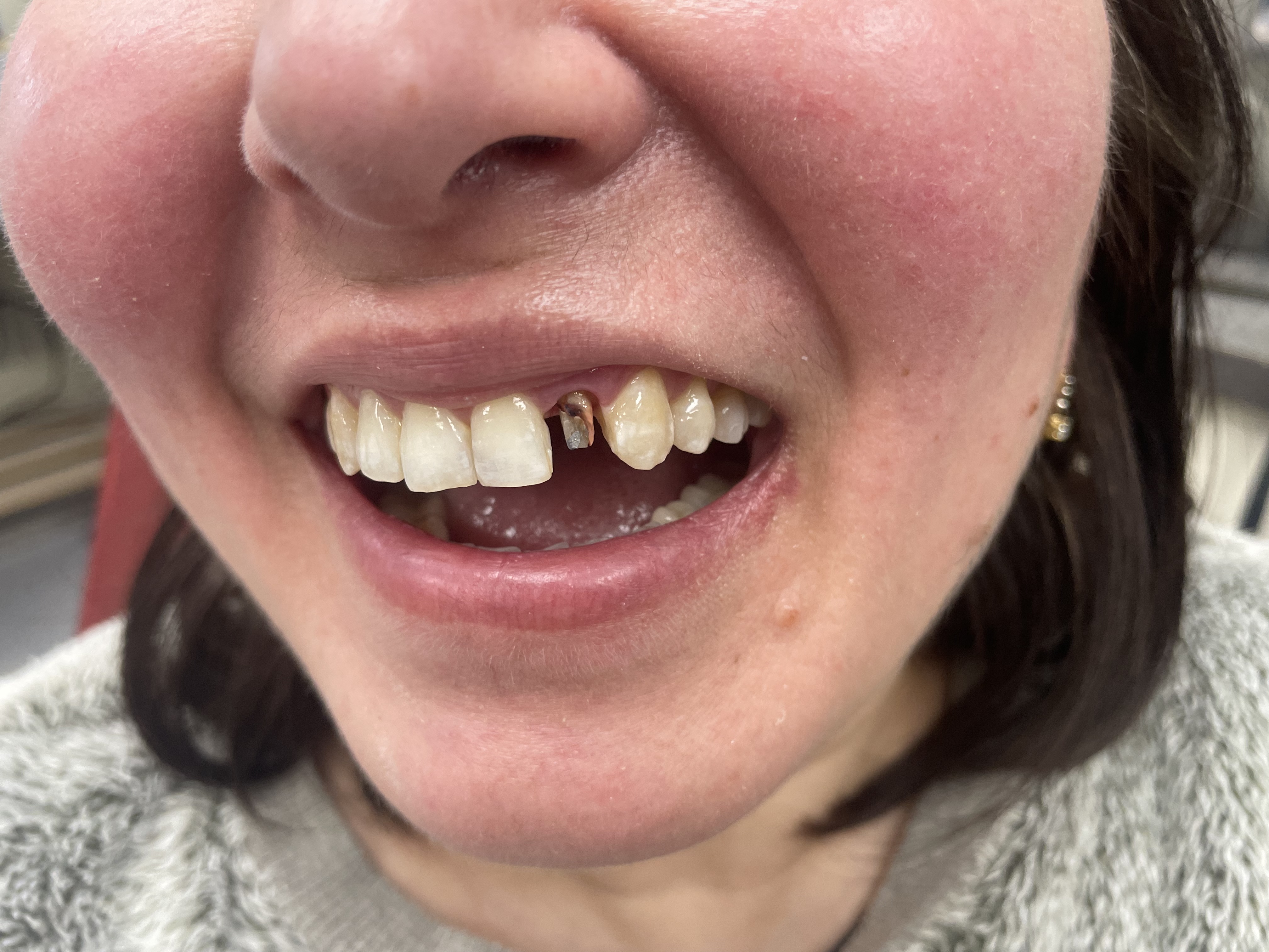 Layered Zirconia